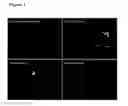 Fig. 02 - Gene therapy for lysosomal storage diseases