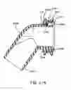Fig. 67 - Nasal mask system
