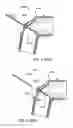 Fig. 82 - Nasal mask system