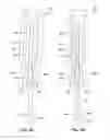 Fig. 08 - Insertion tool for implanting a paddle lead and methods and systems utilizing the tool
