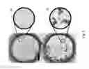 Fig. 08 - MICROBEAD AGGLUTINATION BASED ASSAYS