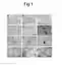 Fig. 02 - BIOMARKERS FOR TANGLE-PREDOMINANT DEMENTIA