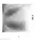 Fig. 07 - Tomosynthesis reconstruction with rib suppression