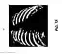 Fig. 08 - Tomosynthesis reconstruction with rib suppression