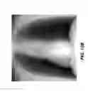 Fig. 14 - Tomosynthesis reconstruction with rib suppression