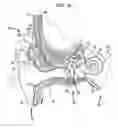 Fig. 02 - MEDICAL DEVICE HAVING AN IMPULSE FORCE-RESISTANT COMPONENT