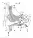 Fig. 03 - MEDICAL DEVICE HAVING AN IMPULSE FORCE-RESISTANT COMPONENT