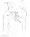Fig. 02 - Identification of abnormal cardiac substrate during left-ventricular pacing