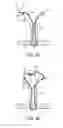 Fig. 03 - Knotless collapsible sutures and methods for suturing