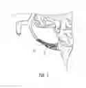 Fig. 02 - Bodily lumen occlusion