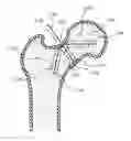 Fig. 01 - Femoral neck support structure, system, and method of use