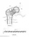 Fig. 02 - Femoral neck support structure, system, and method of use