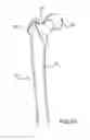 Fig. 03 - Femoral neck support structure, system, and method of use