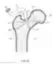 Fig. 06 - Femoral neck support structure, system, and method of use
