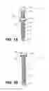 Fig. 02 - Screw Implants For Bone Fusion