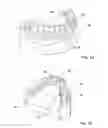 Fig. 02 - DENTAL BRIDGE ATTACHMENT SYSTEM AND METHOD