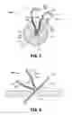 Fig. 04 - Hernia repair device and method