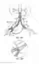 Fig. 28 - Debranching visceral stent graft and methods for use