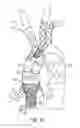 Fig. 33 - Debranching visceral stent graft and methods for use