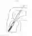 Fig. 08 - Implant having filament limbs of an adjustable loop disposed in a shuttle suture