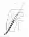 Fig. 09 - Implant having filament limbs of an adjustable loop disposed in a shuttle suture
