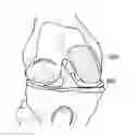 Fig. 01 - Patient Selectable Knee Joint Arthroplasty Devices