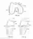 Fig. 21 - Patient Selectable Knee Joint Arthroplasty Devices