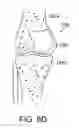Fig. 27 - Patient Selectable Knee Joint Arthroplasty Devices