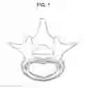Fig. 02 - Method of implanting a curable implant material