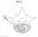 Fig. 06 - Method of implanting a curable implant material