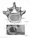 Fig. 02 - Method of distracting an intervertebral space