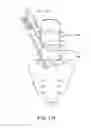 Fig. 35 - Spinal surgery apparatus and method
