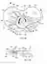 Fig. 09 - Method and apparatus for implanting a knee prosthesis