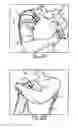 Fig. 10 - SEMI-RIGID SHOULDER BRACES AND RELATED METHODS