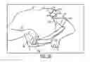 Fig. 14 - SEMI-RIGID SHOULDER BRACES AND RELATED METHODS