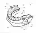 Fig. 01 - Occlusion splint arrangement