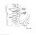Fig. 06 - Embolization