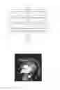 Fig. 02 - Method for identifying calcification portions in dual energy CT contrast agent enhanced scanning image