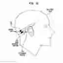 Fig. 06 - Bone conduction device support