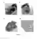 Fig. 10 - Mammal with an orthotopic tumor capable of metastasis, a method of making and a method of using