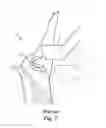 Fig. 02 - Method and device for opening a carcass of a slaughtered animal