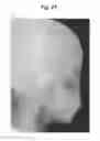 Fig. 28 - X-ray radiographic apparatus, method of measuring head tilt in taking radiograph, stand for X-ray radiographic apparatus, chair for X-ray radiographic apparatus, and head tilt setting device