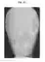 Fig. 35 - X-ray radiographic apparatus, method of measuring head tilt in taking radiograph, stand for X-ray radiographic apparatus, chair for X-ray radiographic apparatus, and head tilt setting device