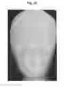 Fig. 37 - X-ray radiographic apparatus, method of measuring head tilt in taking radiograph, stand for X-ray radiographic apparatus, chair for X-ray radiographic apparatus, and head tilt setting device