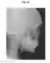 Fig. 44 - X-ray radiographic apparatus, method of measuring head tilt in taking radiograph, stand for X-ray radiographic apparatus, chair for X-ray radiographic apparatus, and head tilt setting device