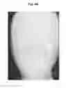Fig. 45 - X-ray radiographic apparatus, method of measuring head tilt in taking radiograph, stand for X-ray radiographic apparatus, chair for X-ray radiographic apparatus, and head tilt setting device