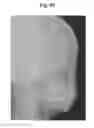 Fig. 46 - X-ray radiographic apparatus, method of measuring head tilt in taking radiograph, stand for X-ray radiographic apparatus, chair for X-ray radiographic apparatus, and head tilt setting device
