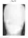 Fig. 47 - X-ray radiographic apparatus, method of measuring head tilt in taking radiograph, stand for X-ray radiographic apparatus, chair for X-ray radiographic apparatus, and head tilt setting device
