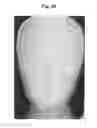 Fig. 49 - X-ray radiographic apparatus, method of measuring head tilt in taking radiograph, stand for X-ray radiographic apparatus, chair for X-ray radiographic apparatus, and head tilt setting device