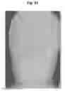 Fig. 52 - X-ray radiographic apparatus, method of measuring head tilt in taking radiograph, stand for X-ray radiographic apparatus, chair for X-ray radiographic apparatus, and head tilt setting device